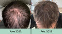 Understanding Hair Loss: What Actually Works (And What I Learned After Spending $1,300 on a Red Light Helmet)